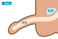 埋没修正術 施術後