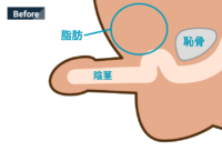 恥骨前脂肪吸引併用長茎術 施術前