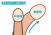 陰茎の途中から湾曲（左右）
