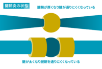 【腱鞘炎の状態】腱鞘が厚くなり腱が通りにくくなっている／腱が太くなり腱鞘を通りにくくなっている