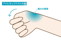 アイヒホッフテストの例